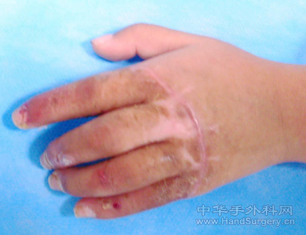 术后2月复查