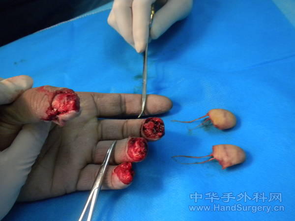 两侧的神经都抽了出来，