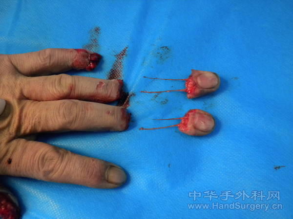 离断指体有明显积压痕迹