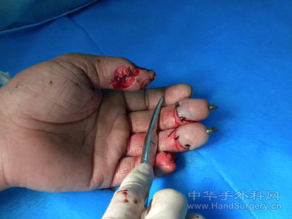 术后中指一动两静环指两动一静，不知道能不能活，术后3天了目前血运还好