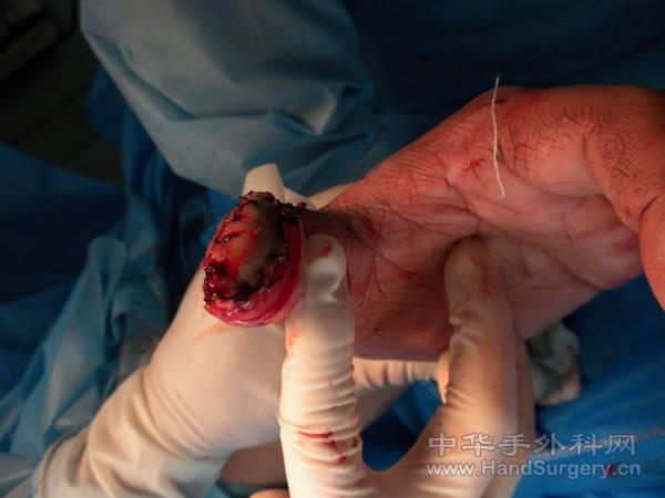 拇指尺背侧皮瓣