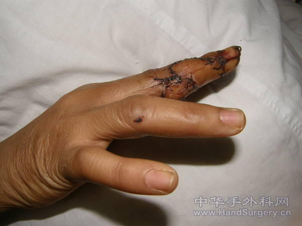 c型皮瓣修复术后