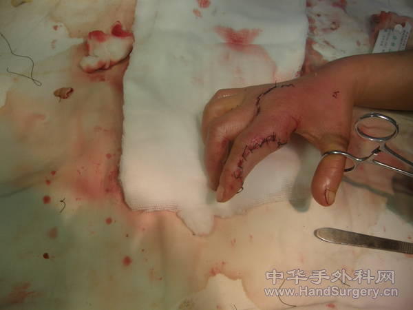 修复术后