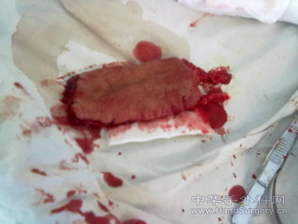 足背复合组织瓣