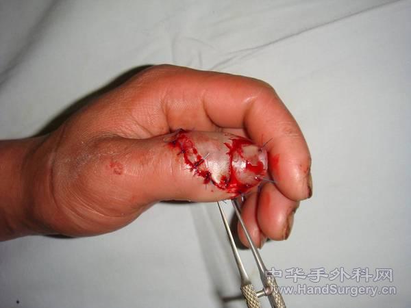 术中吻合指腹部一根及指背部各1根静脉