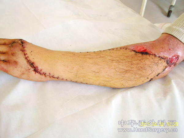 术后十五天拆线3.jpg