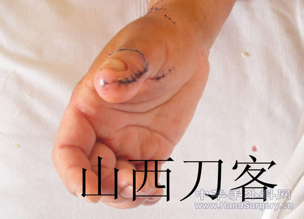 拇指末节缺损拇甲瓣修复