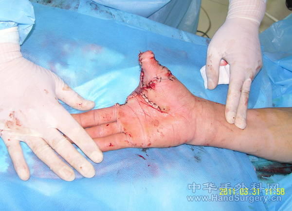 术后1.jpg