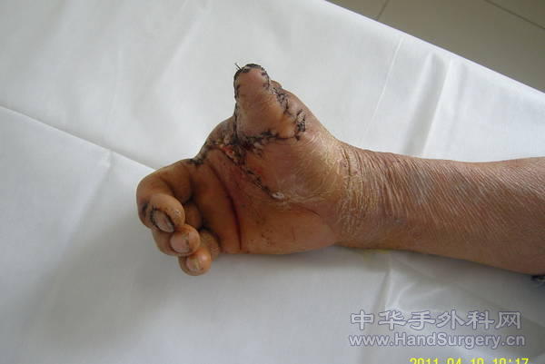 术后10天1.jpg