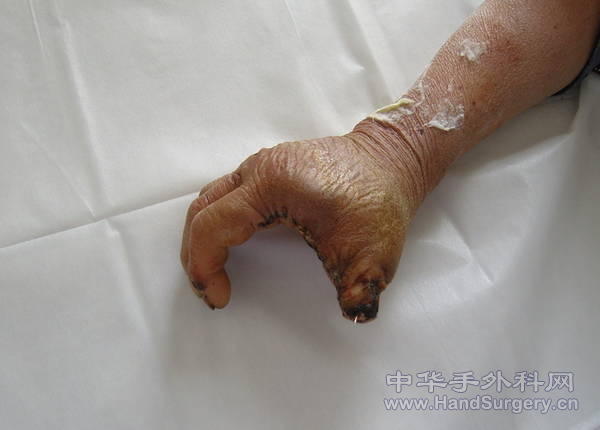术后10天2.jpg