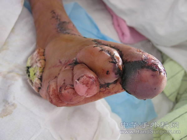 本想用附外侧和踝前双叶，术中见植皮困难可能造成二次手术，临时改行附外侧和附内侧 ...