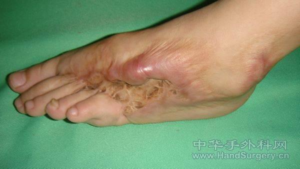 右足正常X线片