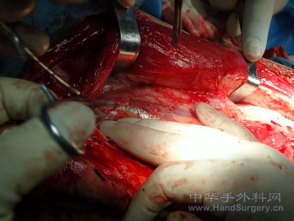 显露旋股外侧动脉1.jpg
