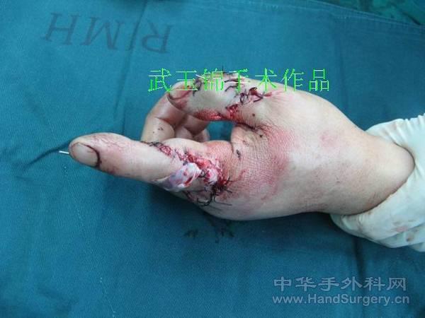 术后0.JPG