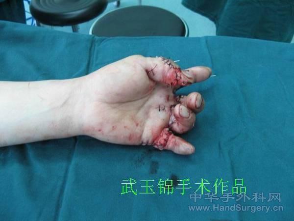 术后1.JPG