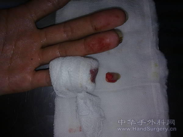 此病人来院时用冰棍包着过来。没有其它敷料相隔我们主任看完说没用了。放弃再植。我同患者沟通后。患者愿意 ...
