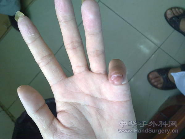 这是术后一个月复查。外观久佳，但患者还算满意。