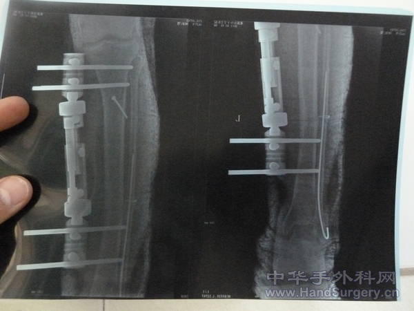 术后复查X片情况