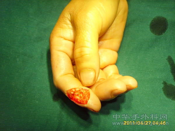 右手食指远指间关节桡侧皮肤缺损