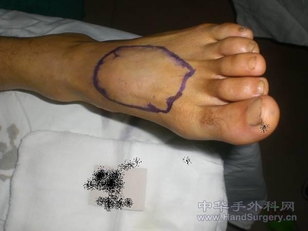 足背游离皮瓣