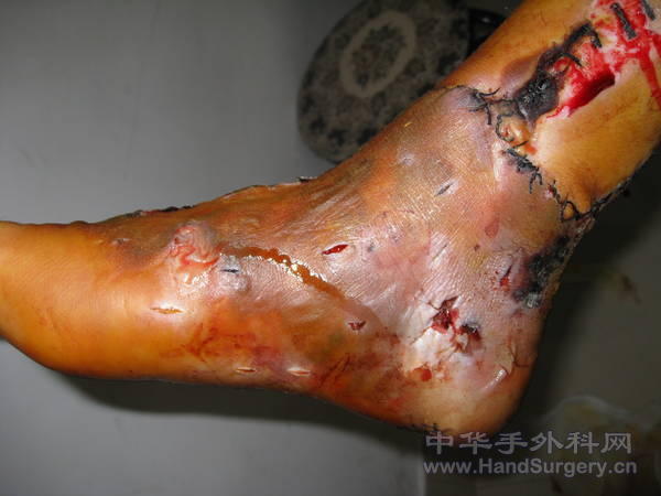 1手术后皮肤出现坏死.jpg