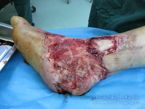坏死组织清除后.jpg