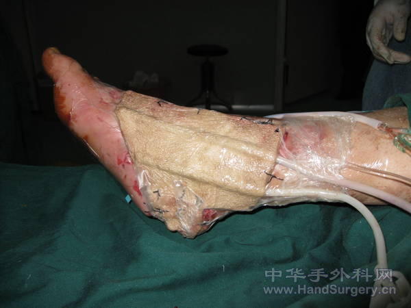 VSD覆盖术后.jpg