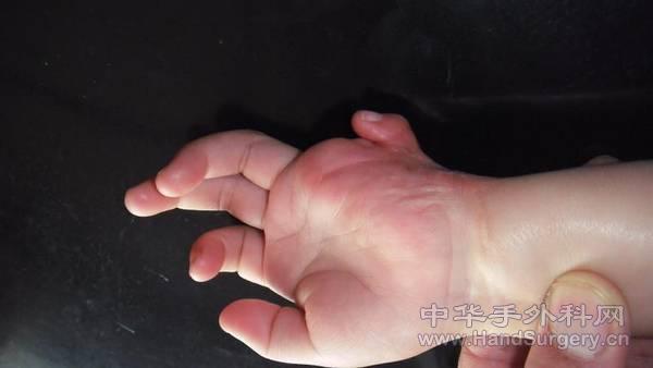 烧伤疤痕01