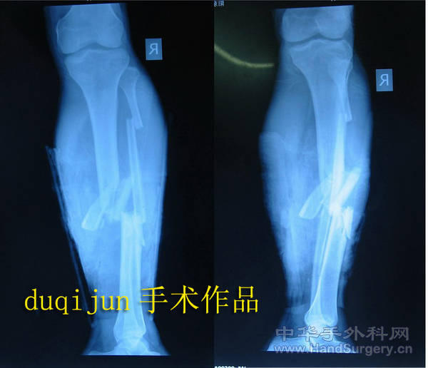 术前X光片