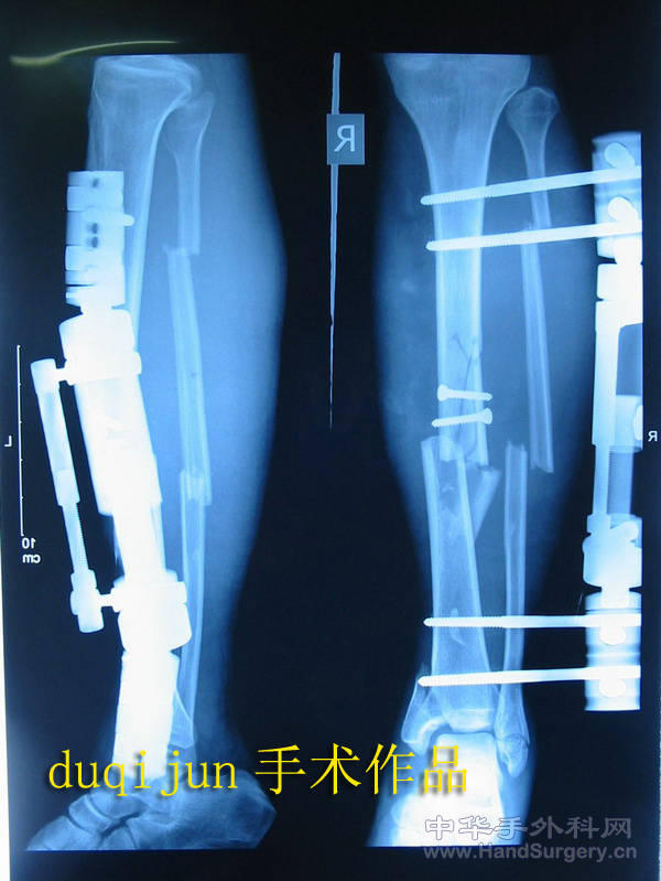术后X光片