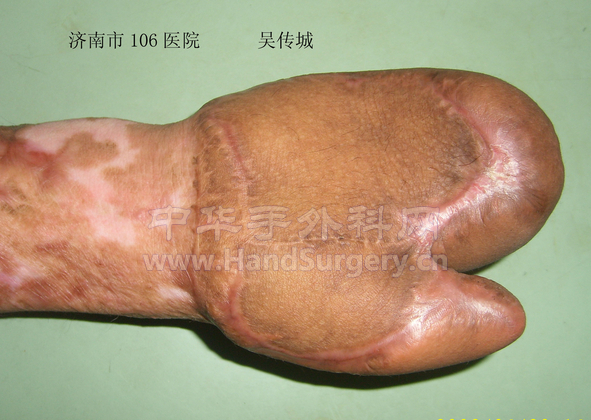 皮瓣修复术后