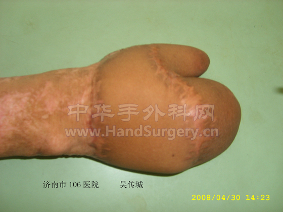 皮瓣修复术后