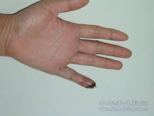 术后1.jpg