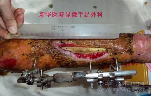全小腿皮肤撕脱伤 (2).JPG