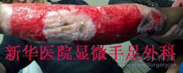 全小腿皮肤撕脱伤 (3).JPG
