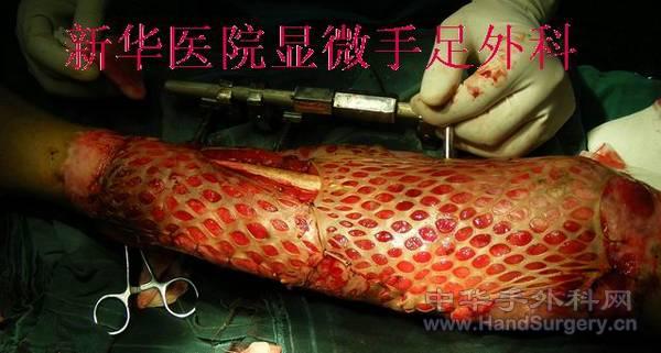 全小腿皮肤撕脱伤 (4).JPG