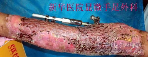 全小腿皮肤撕脱伤 (6).JPG