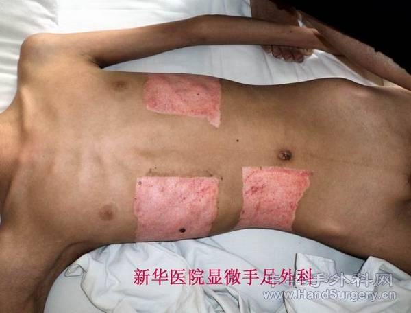 全小腿皮肤撕脱伤 (8).JPG