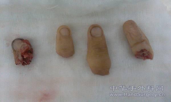 右示指已毁损