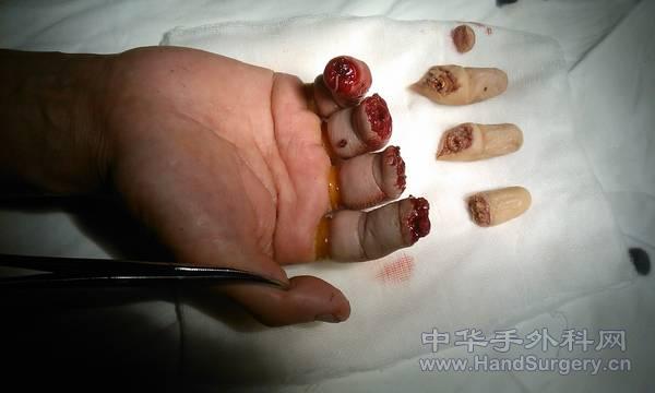 用左手小指替代