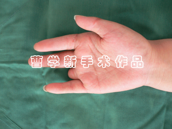 术后1