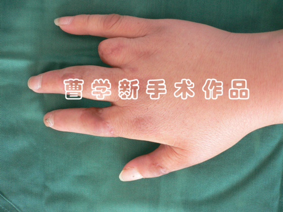 术后2