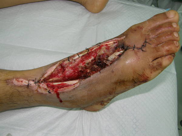 右足组织损伤情况