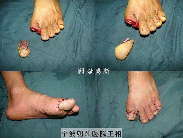 趾趾尖离断.jpg