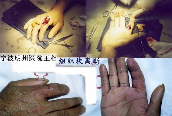 贯通组织块离断.jpg