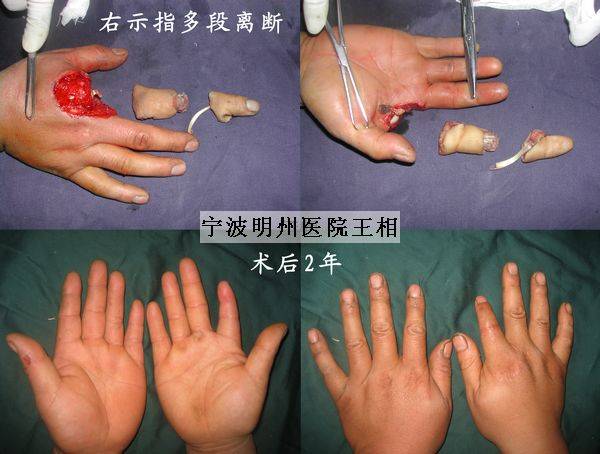 右示指多段离断.jpg