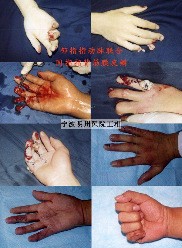 邻指指动脉联合同指指背筋膜皮瓣.jpg