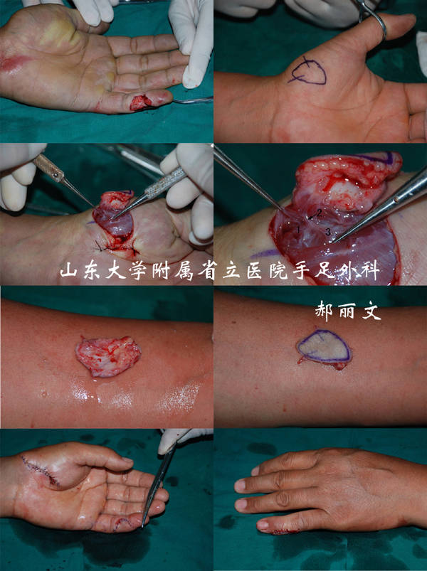 鱼际皮支皮瓣游离移植-.jpg