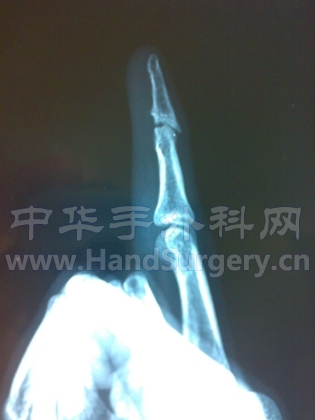 现在的拍片(示指)