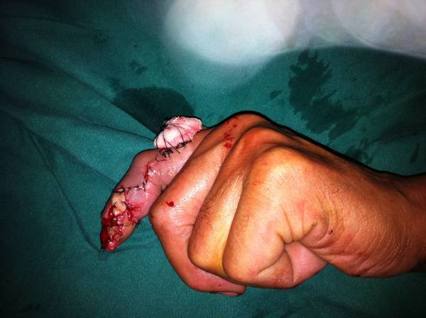 蒂部缝合感觉有点紧，就植皮缝合了。